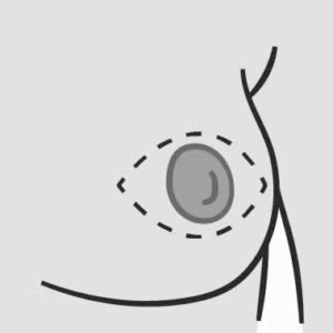 Skin Sparing Mastectomy