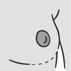 Nipple Sparing Mastectomy