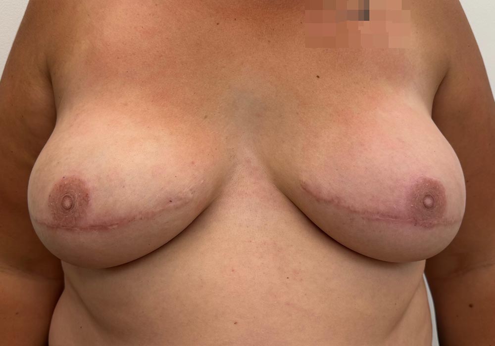 Non-nipple-Sparing-Mastectomy-After-Tattoos-1000px.jpg