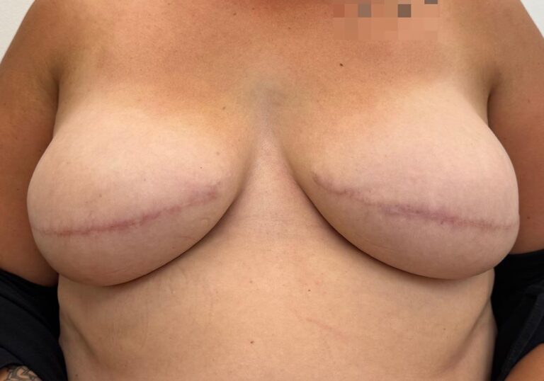 Non-nipple-Sparing-Mastectomy-Before-Tattoos-1000px