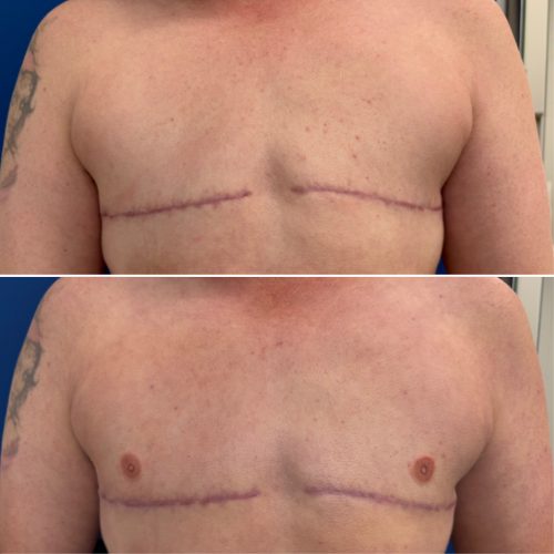 Before and After Nipple Tattoo