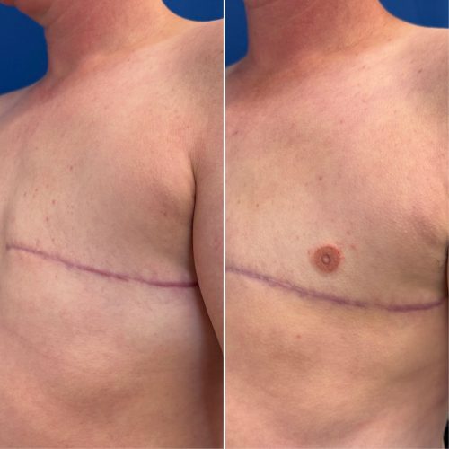 Before and After Nipple Tattoo