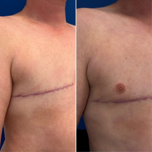 Before and After Nipple Tattoo