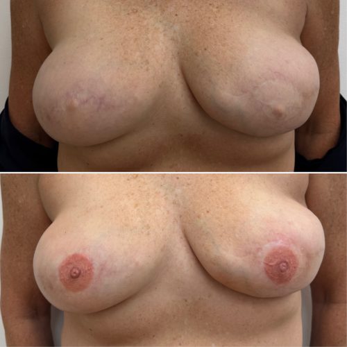 Before and After Nipple Tattoo