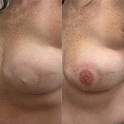 Before and After Nipple Tattoo