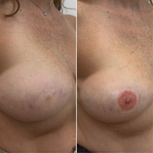 Before and After Nipple Tattoo