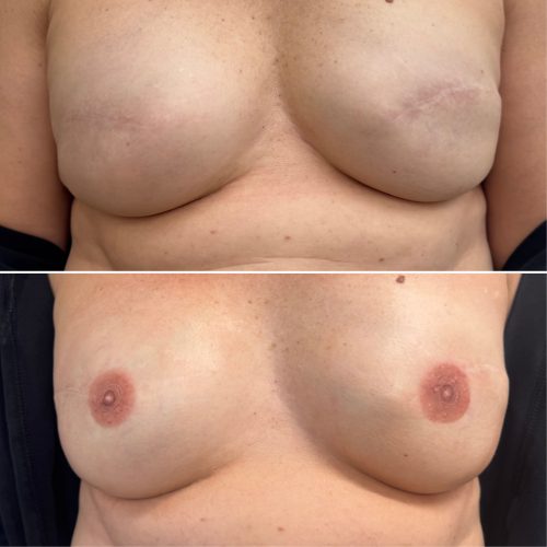 Before and After Nipple Tattoo