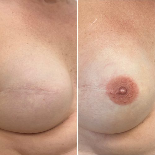 Before and After Nipple Tattoo