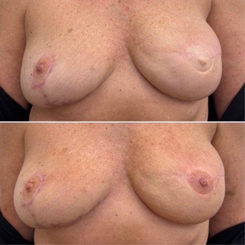 Before and After Nipple Tattoo