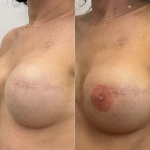 Before and After Nipple Tattoo
