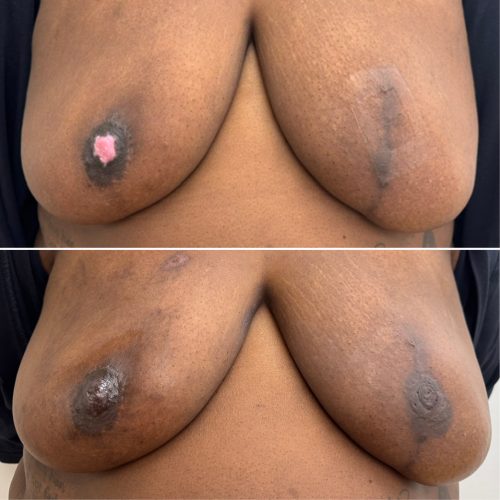 Before and After Nipple Tattoo